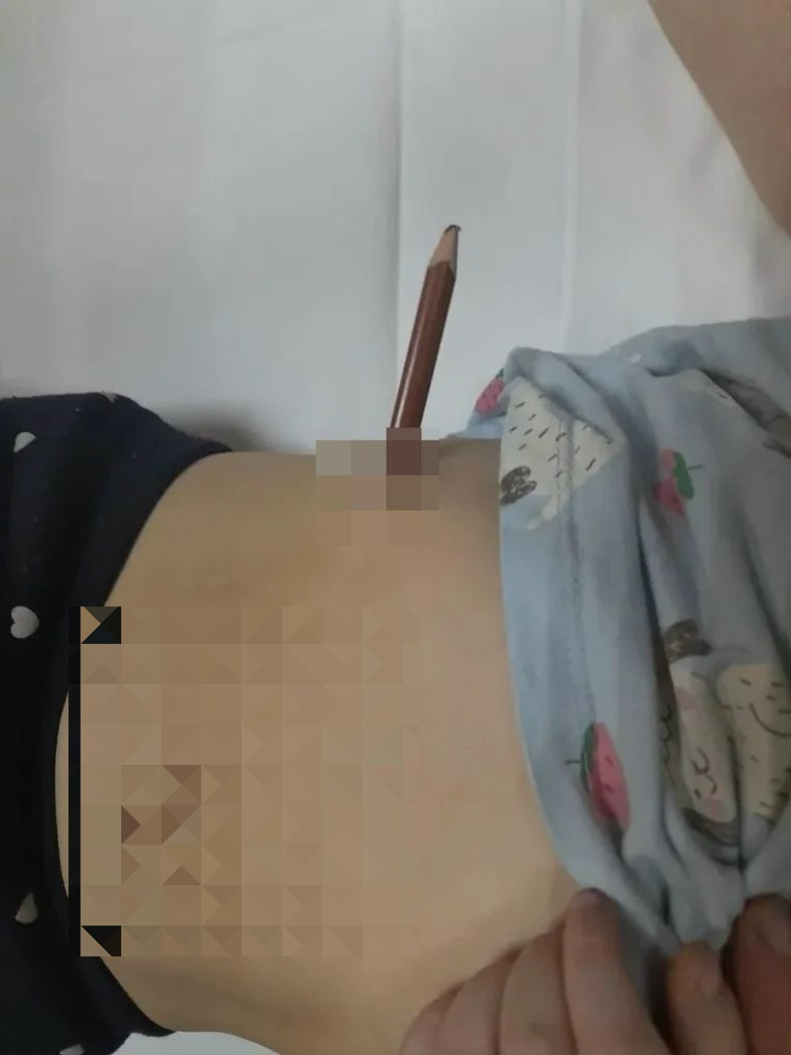 В Башкирии врачи спасли мальчика с карандашом в животе