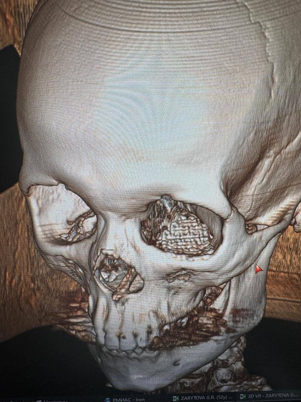 В Башкирии врачи восстановили часть лица бойцу СВО после боевой травмы