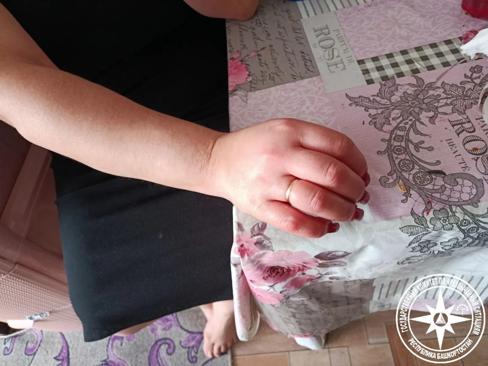 Из-за отёка пальца жительница Башкирии не смогла снять кольцо