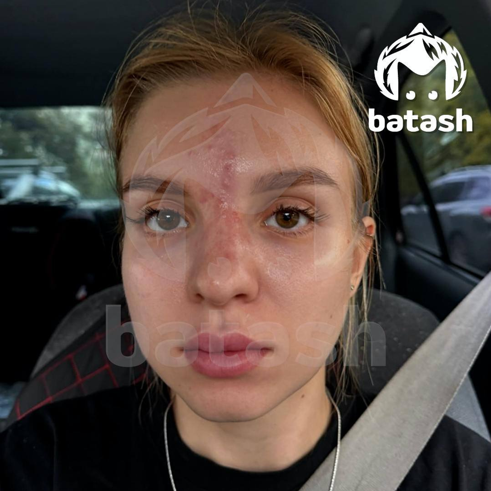 В Башкирии бровистка пострадала после «уколов красоты»