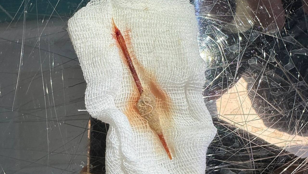 Башкирские врачи удалили зубочистку из тела семилетнего ребёнка